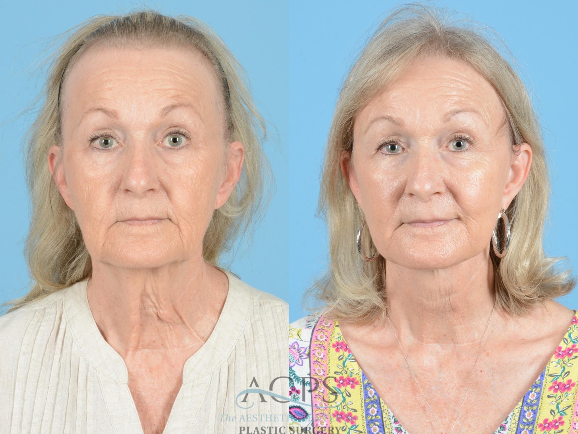 Before & After Fraxel Case 1222 Front View: View in Houston, TX