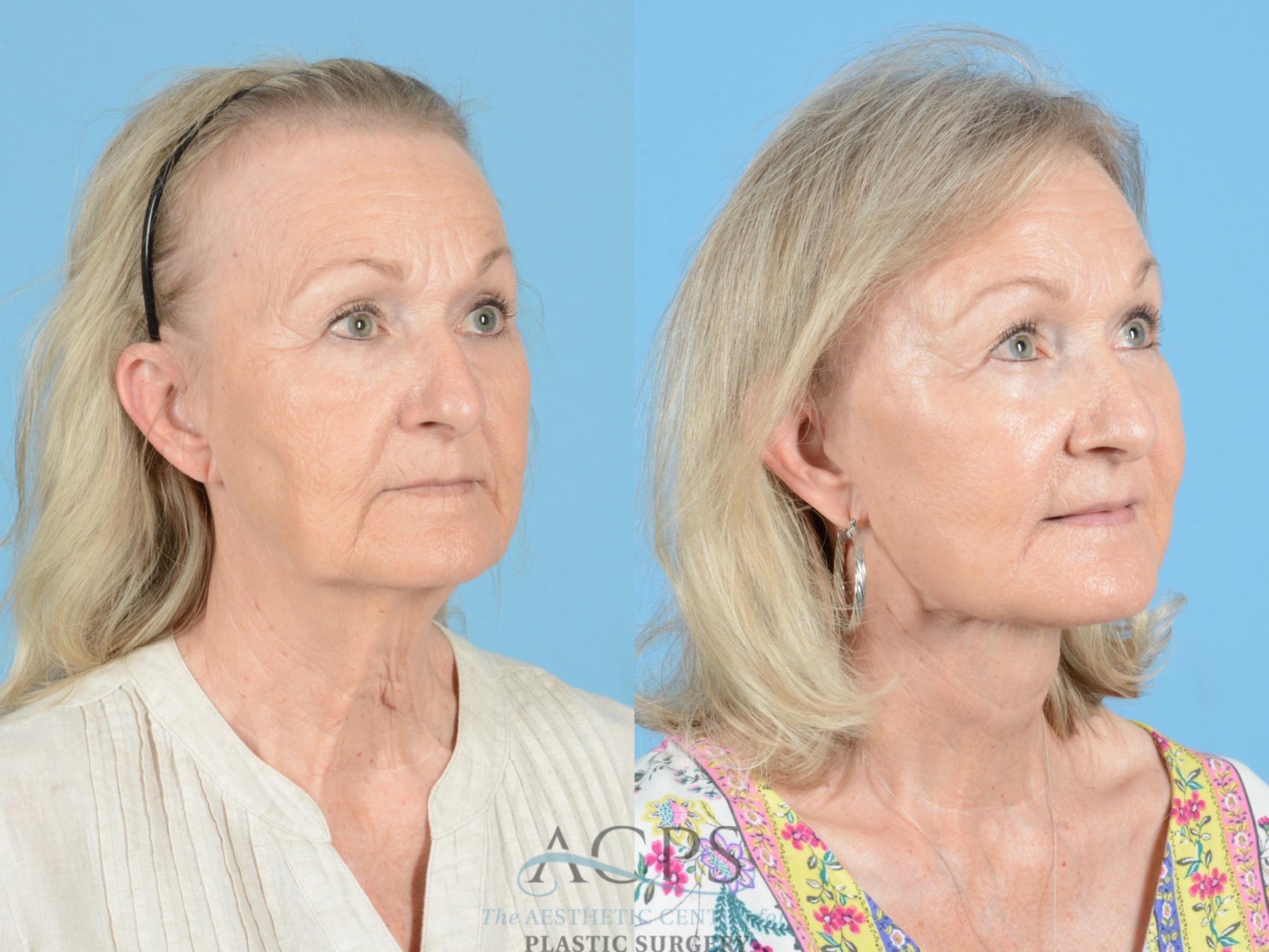 Before & After Fraxel Case 1222 Oblique View: View in Houston, TX