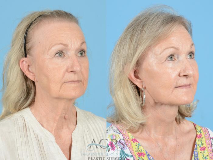 Before & After Fraxel Case 1222 Oblique View: View in Houston, TX