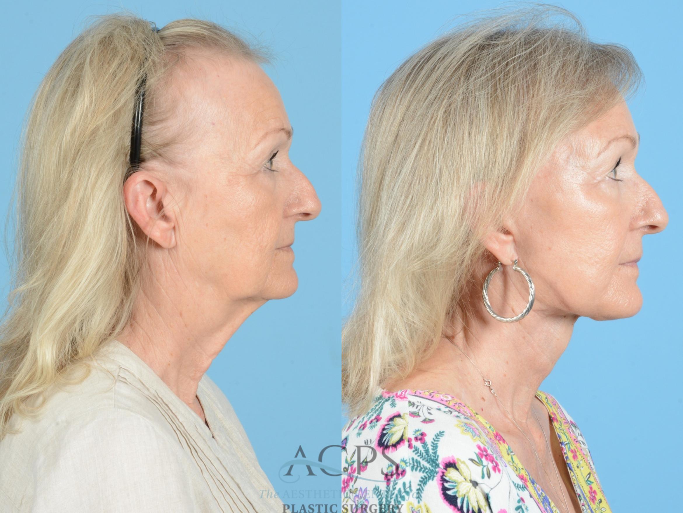 Before & After Fraxel Case 1222 Side View: View in Houston, TX