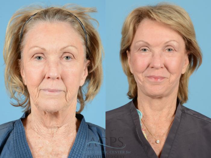 Before & After Facelift Case 1223 Front View: View in Houston, TX