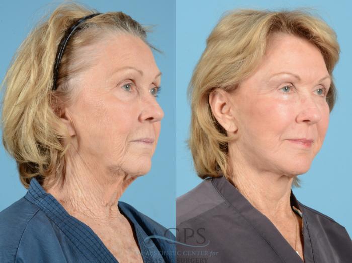 Before & After Facelift Case 1223 Oblique View: View in Houston, TX