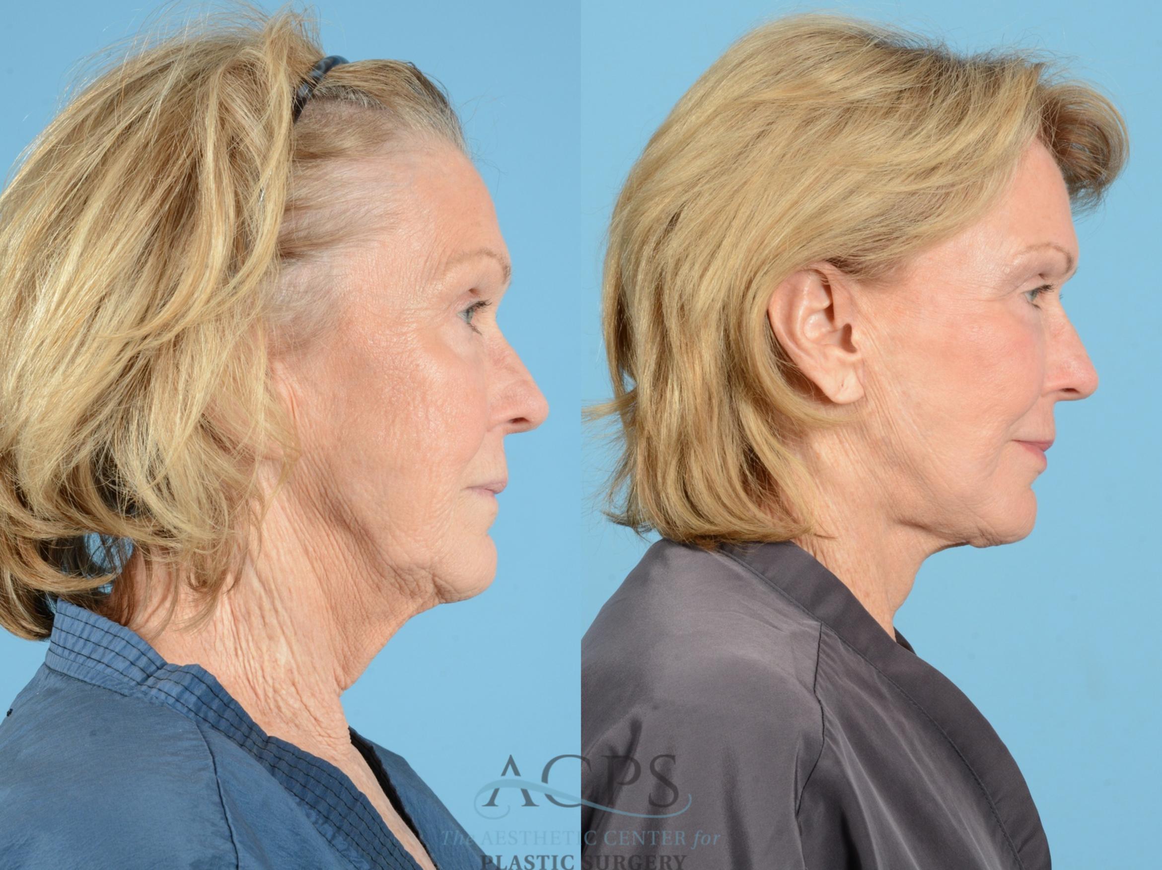 Before & After Facelift Case 1223 Right Side View: View in Houston, TX