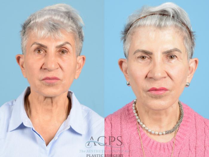 Before & After Neck Lift Case 1224 Front View: View in Houston, TX