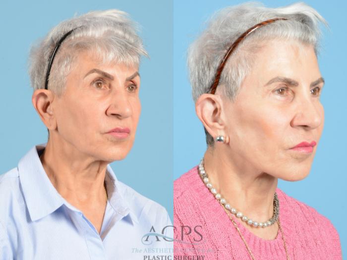 Before & After Neck Lift Case 1224 Oblique View: View in Houston, TX