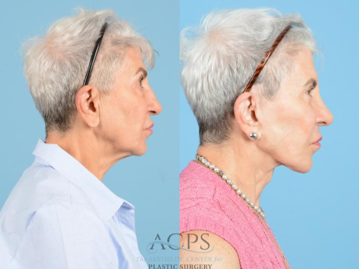 Before & After Neck Lift Case 1224 Right Side View: View in Houston, TX