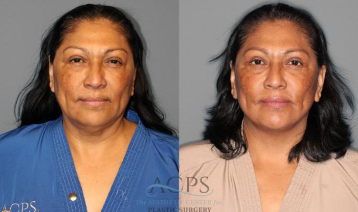 Before & After Eyelid Surgery Case 1225 Front View: View in Houston, TX