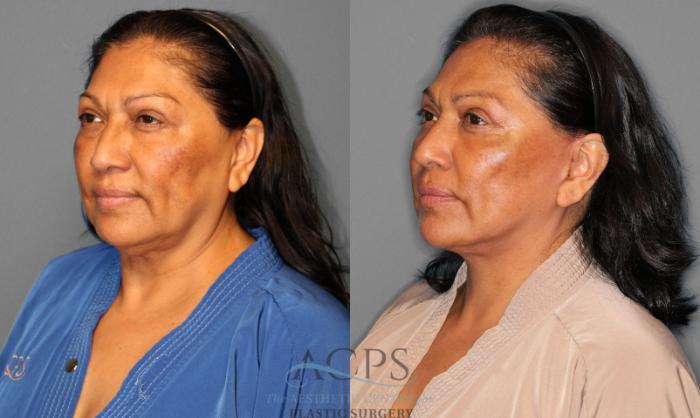 Before & After Facelift Case 1225 Oblique View: View in Houston, TX