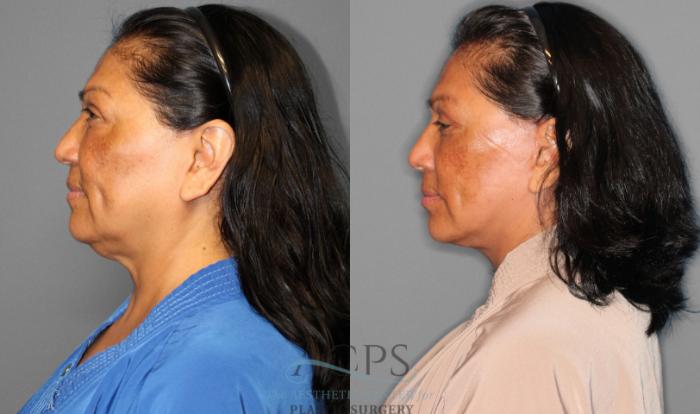 Before & After Facelift Case 1225 Side View: View in Houston, TX
