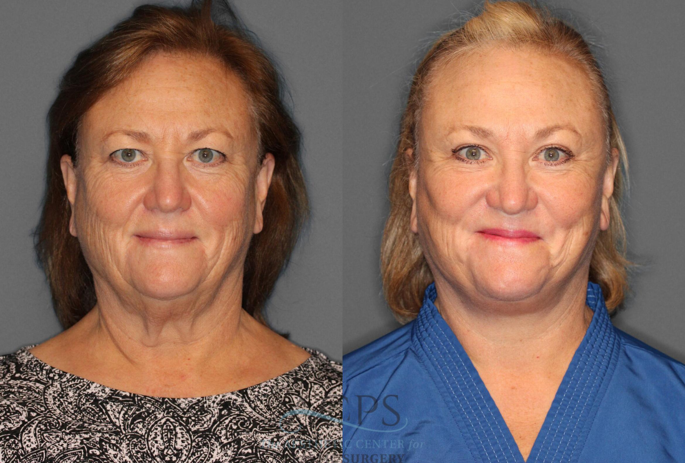 Before & After Facelift Case 1226 Front View: View in Houston, TX
