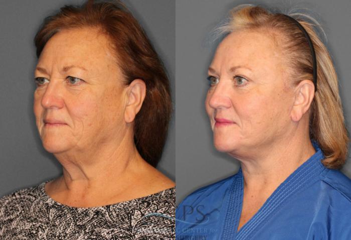 Before & After Facelift Case 1226 Oblique View: View in Houston, TX