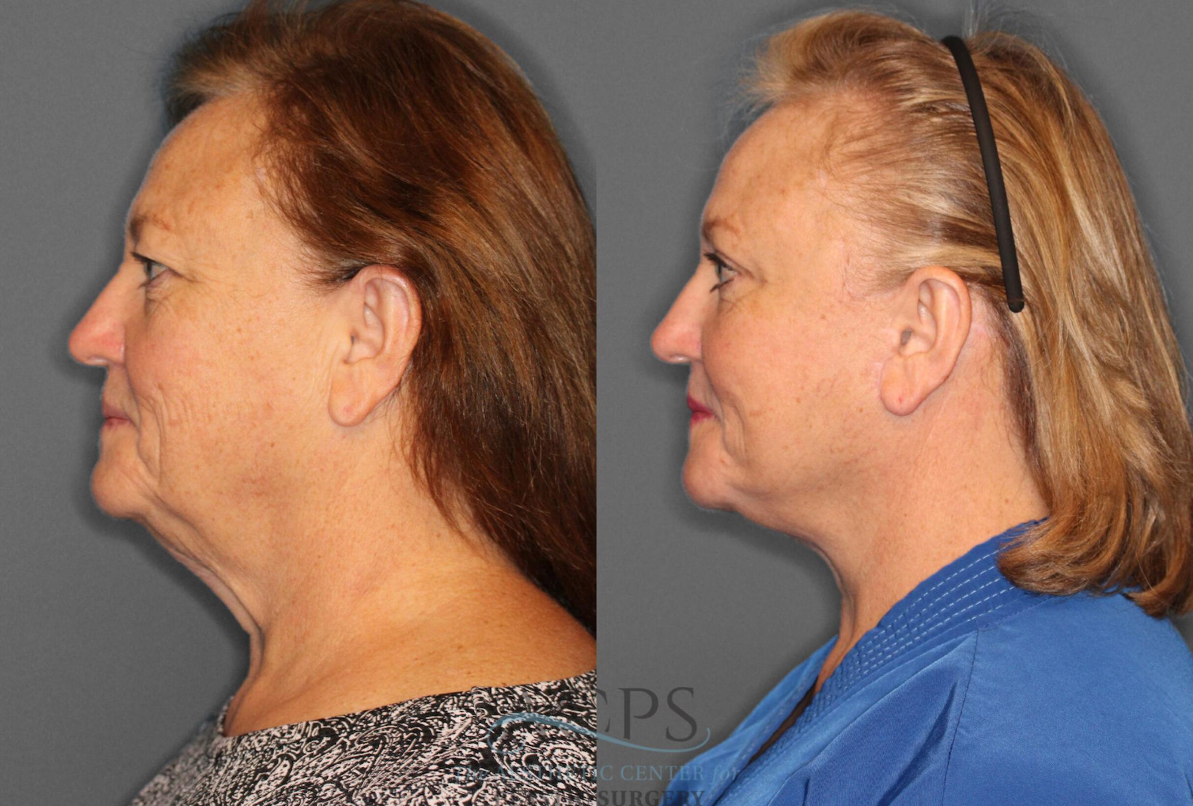 Before & After Facelift Case 1226 Side View: View in Houston, TX