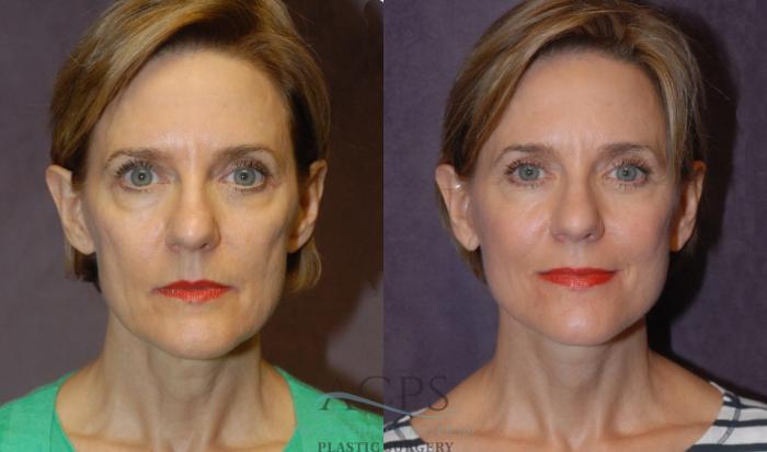 Before & After Facelift Case 1227 Front View: View in Houston, TX