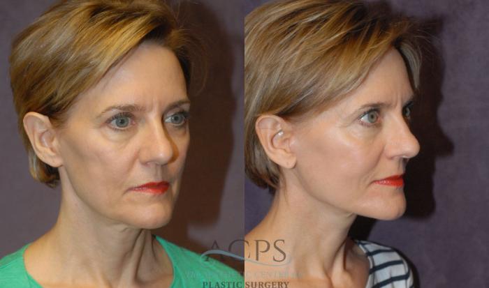 Before & After Facelift Case 1227 Oblique View: View in Houston, TX
