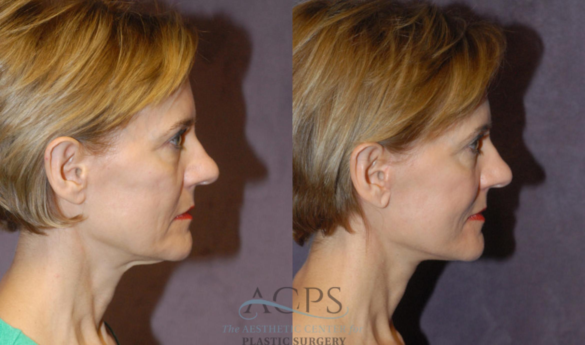 Before & After Facelift Case 1227 Side View: View in Houston, TX