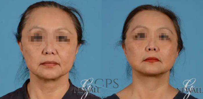 Before & After Facelift Case 1229 Front View: View in Houston, TX