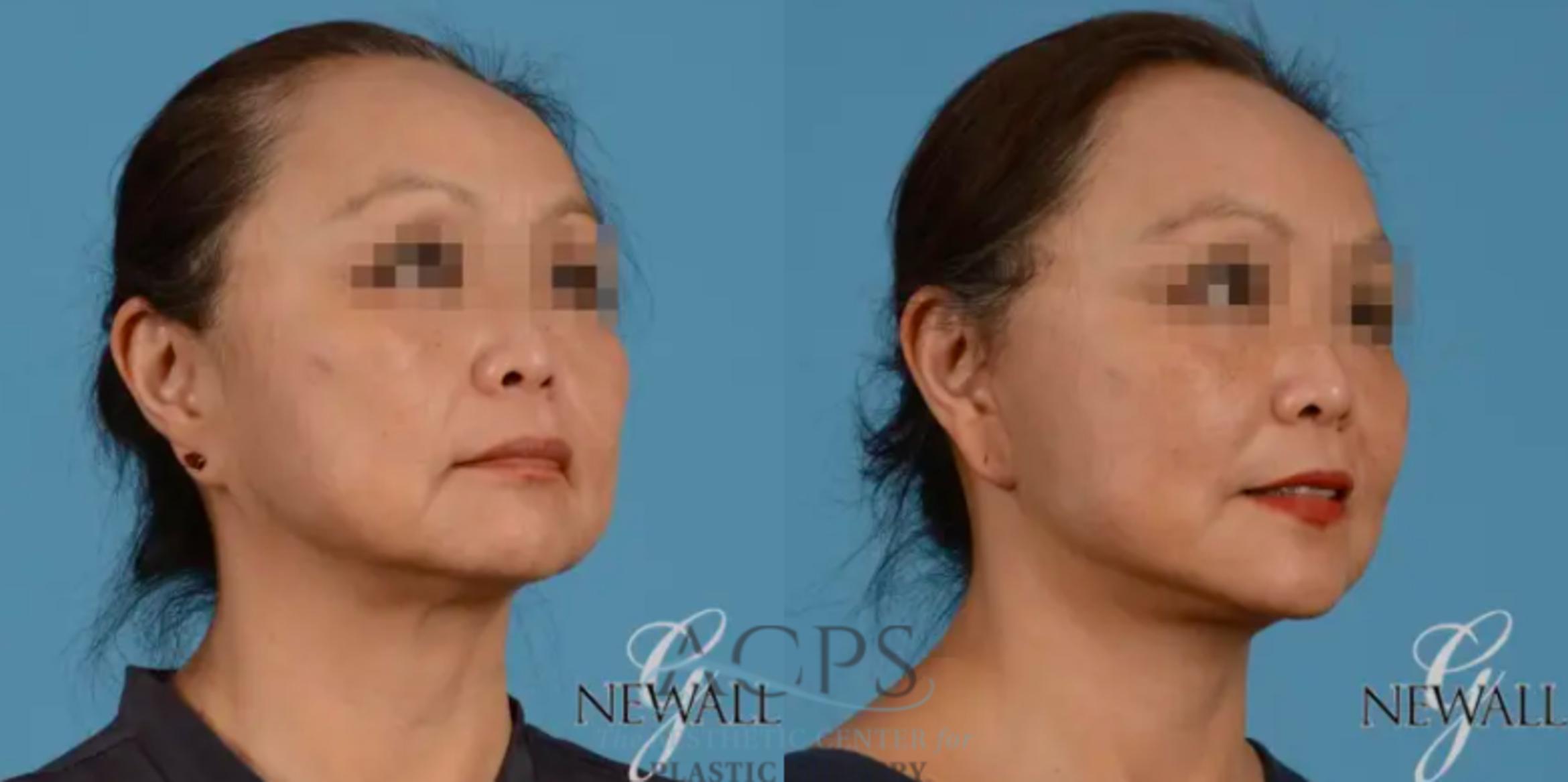 Before & After Facelift Case 1229 Oblique View: View in Houston, TX