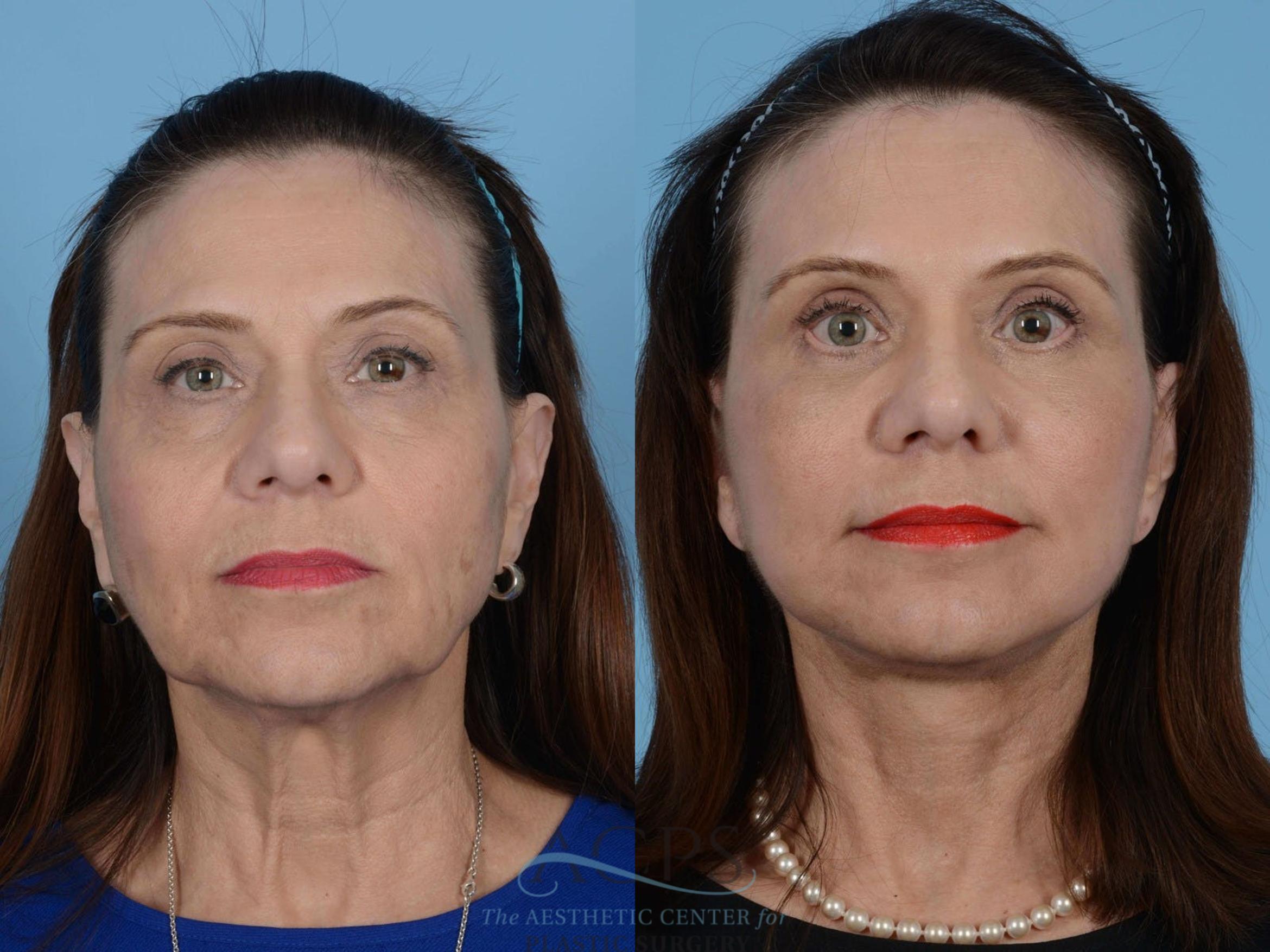 Before & After Facelift Case 1230 Front View: View in Houston, TX