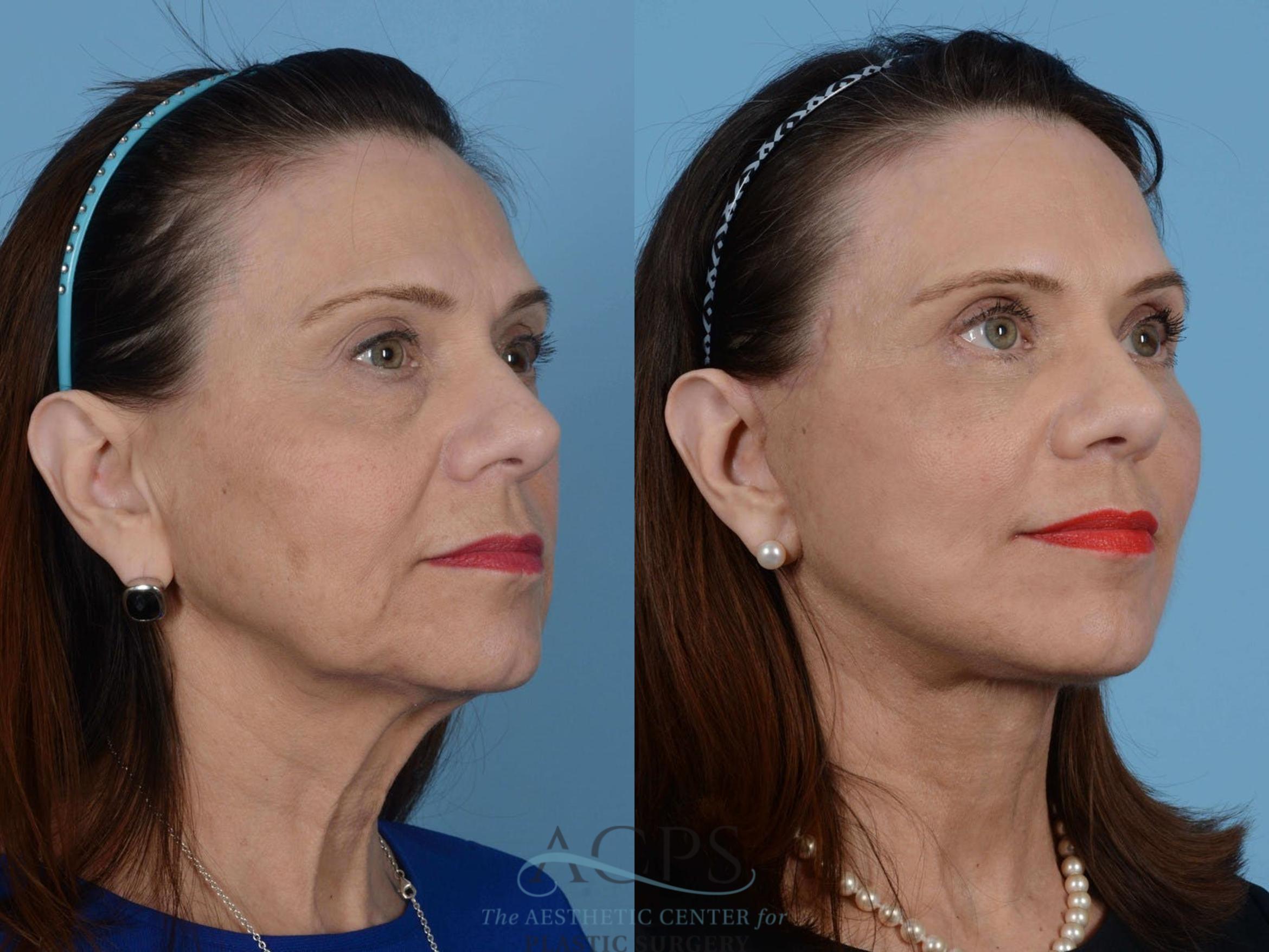 Before & After Facelift Case 1230 Oblique View: View in Houston, TX