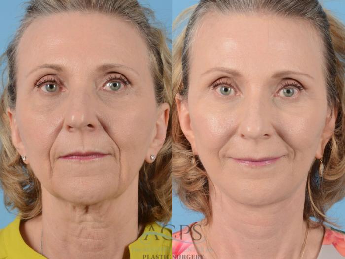 Before & After Facelift Case 1231 Front View: View in Houston, TX