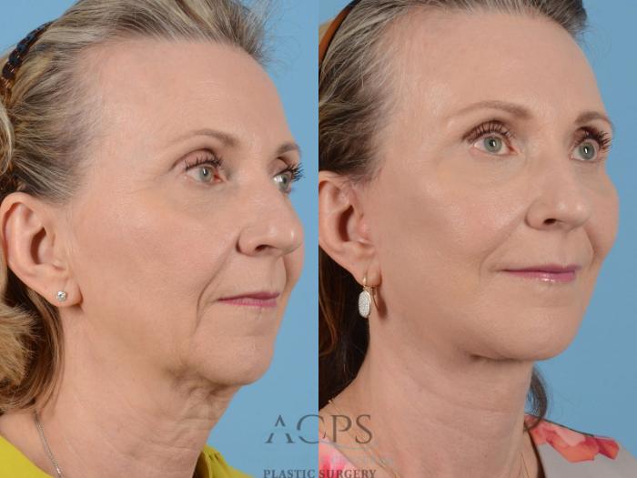 Before & After Facelift Case 1231 Oblique View: View in Houston, TX