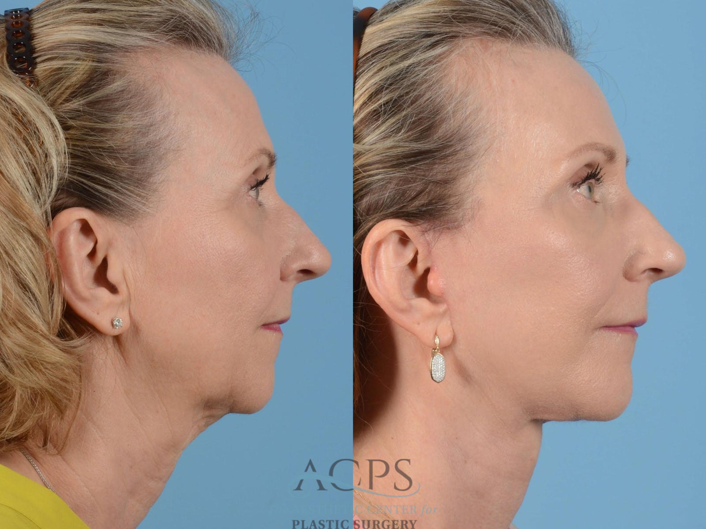 Before & After Facelift Case 1231 Side View: View in Houston, TX