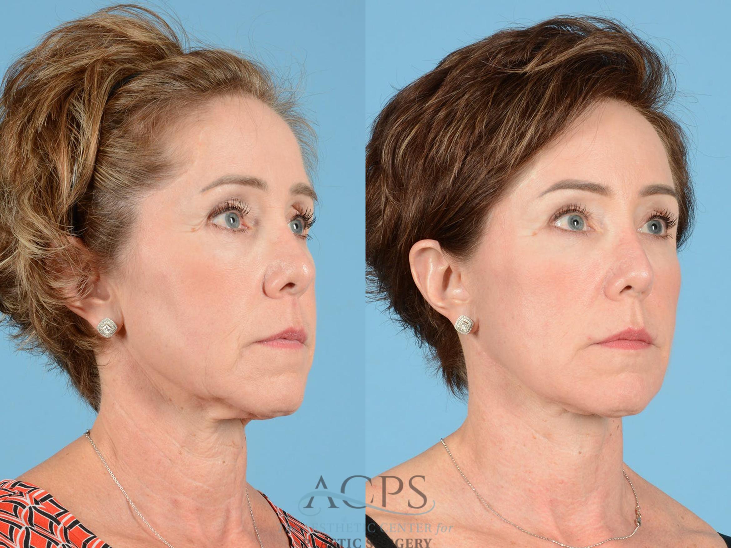 Before & After Facelift Case 1232 Oblique View: View in Houston, TX