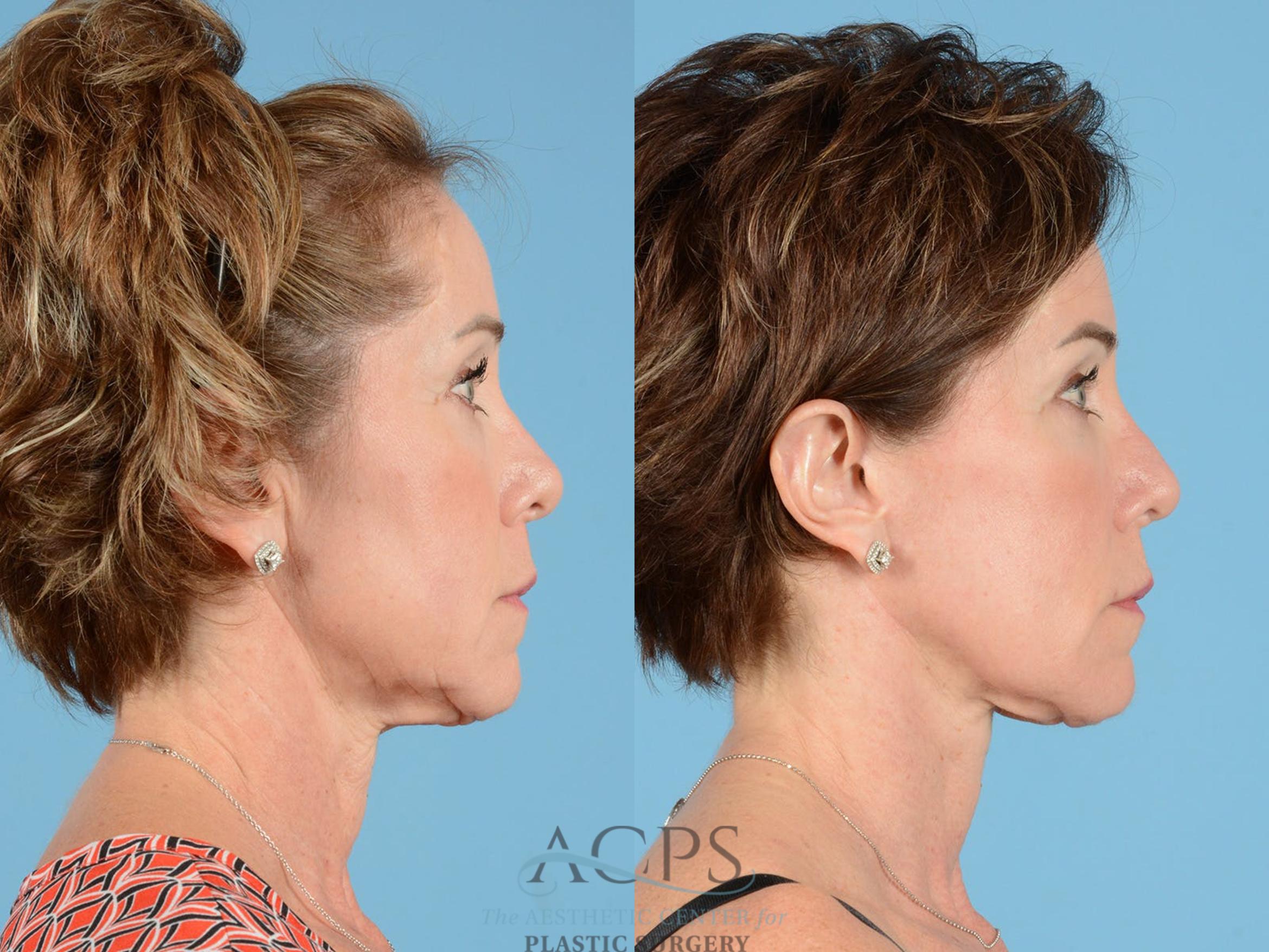 Before & After Facelift Case 1232 Side View: View in Houston, TX