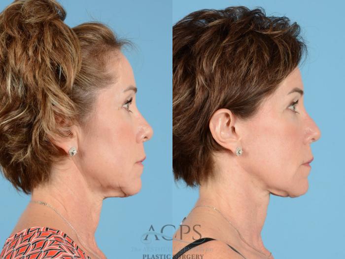 Before & After Facelift Case 1232 Side View: View in Houston, TX