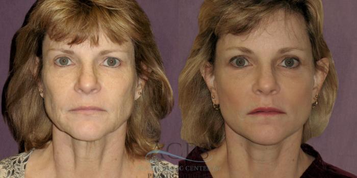 Before & After Neck Lift Case 1233 Front View: View in Houston, TX