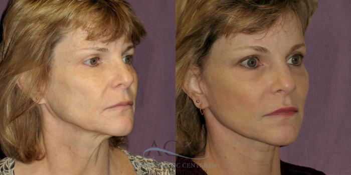 Before & After Neck Lift Case 1233 Oblique Right View: View in Houston, TX