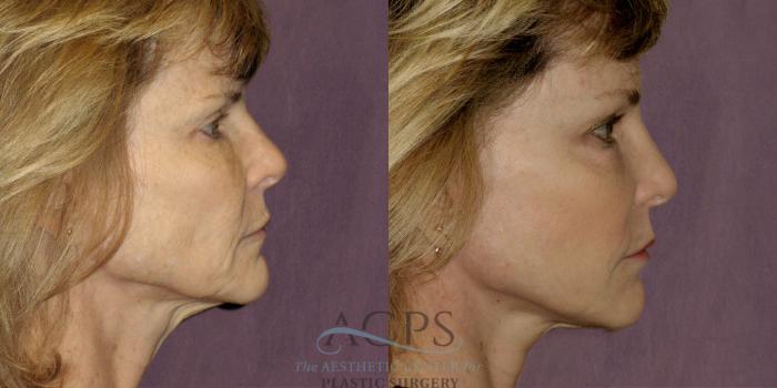 Before & After Neck Lift Case 1233 Side Right View: View in Houston, TX