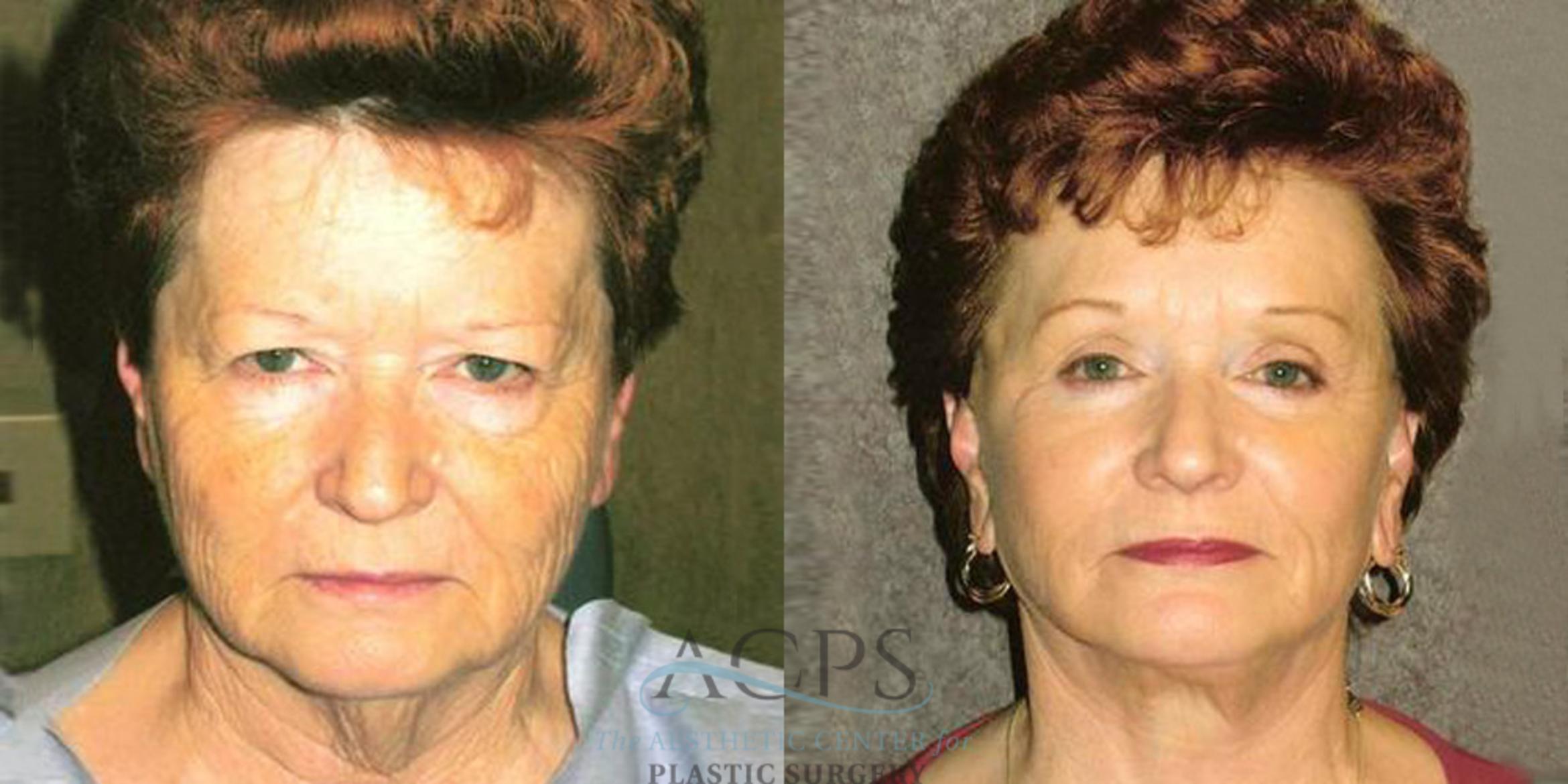 Before & After Facelift Case 1234 Front View: View in Houston, TX