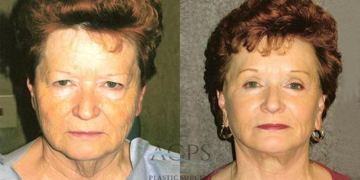 Before & After Facelift Case 1234 Front View: View in Houston, TX
