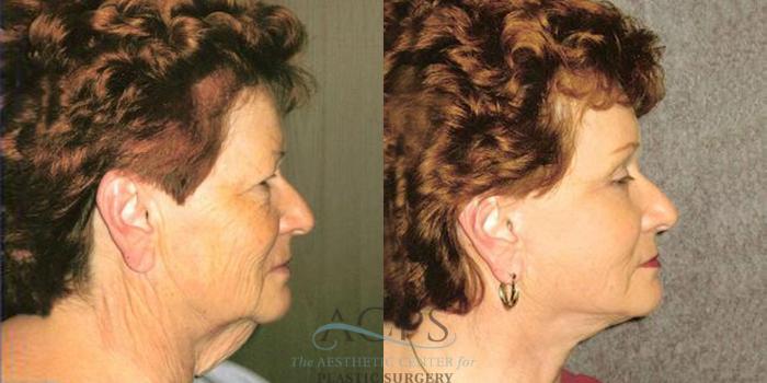Before & After Facelift Case 1234 Side Right View: View in Houston, TX