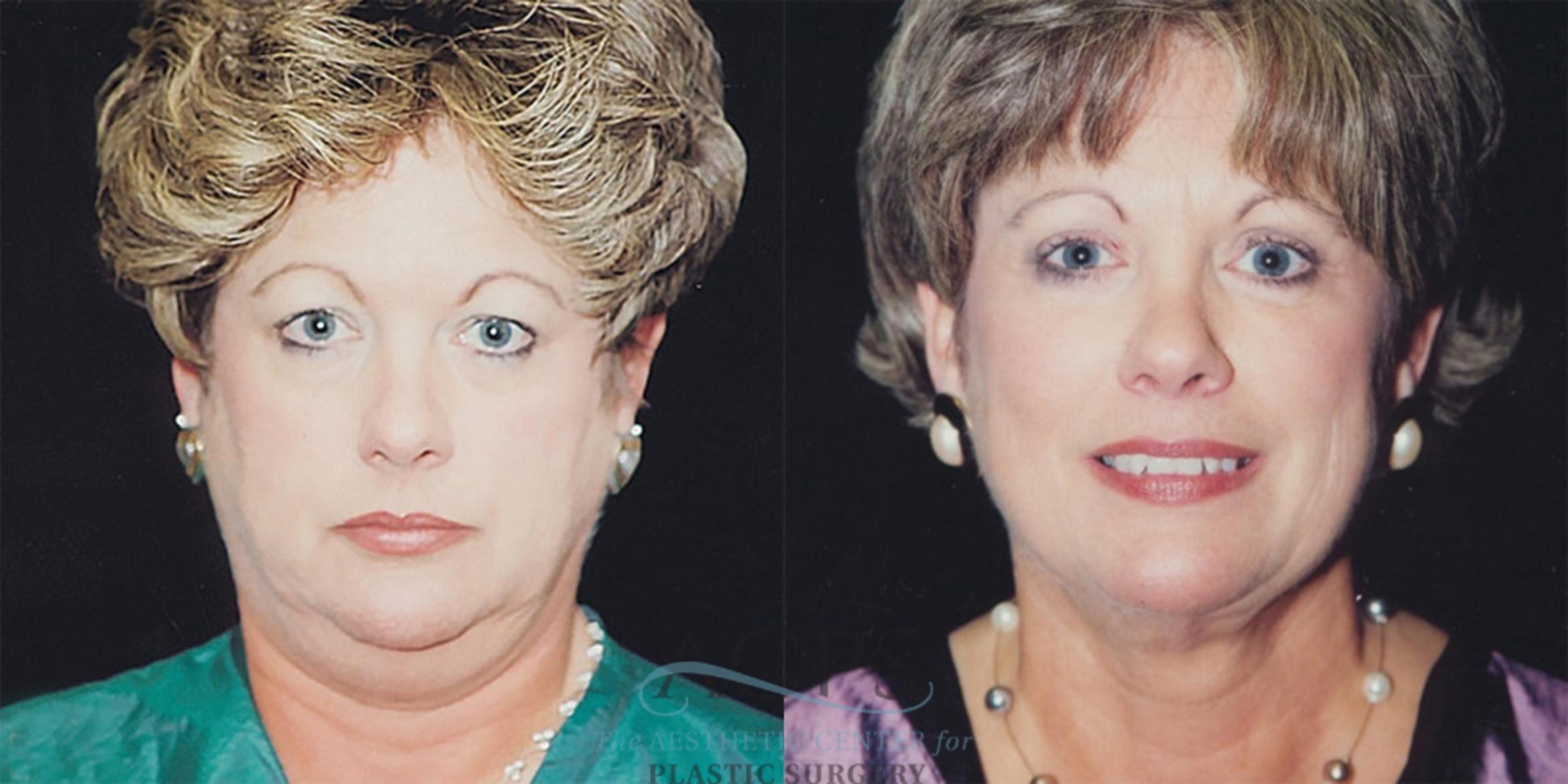 Before & After Neck Lift Case 1235 Front View: View in Houston, TX