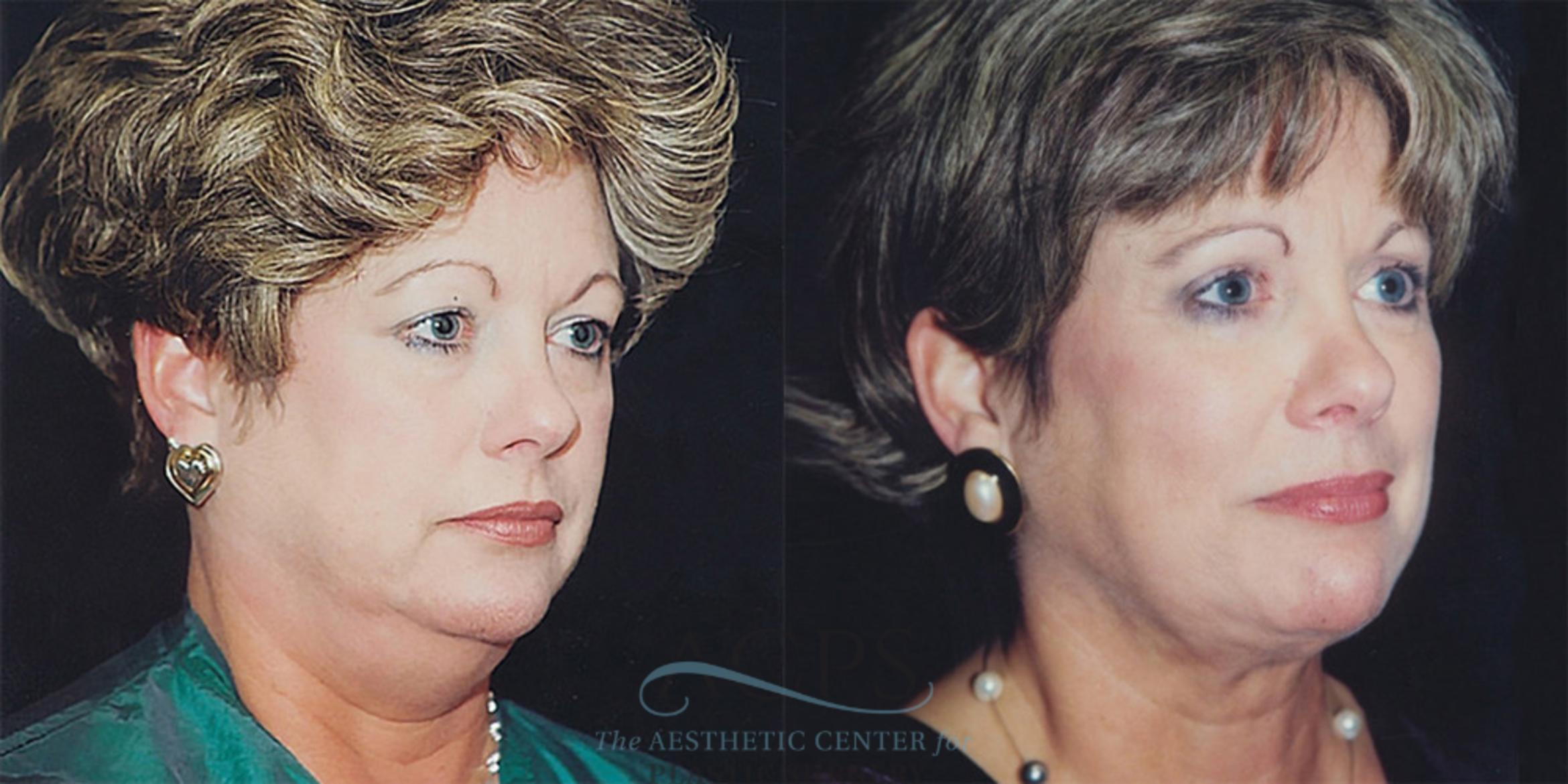Before & After Neck Lift Case 1235 Oblique Left View: View in Houston, TX
