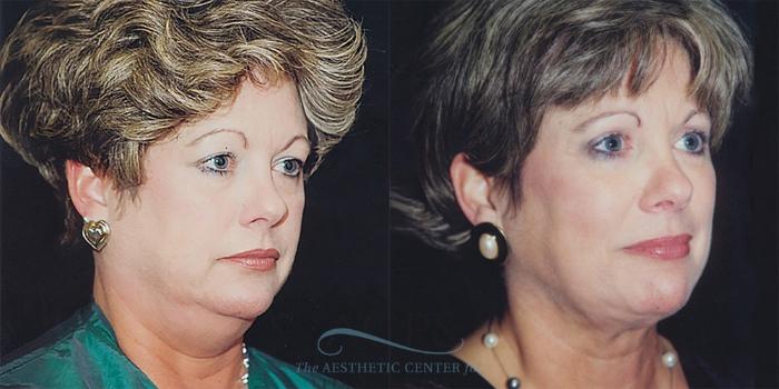 Before & After Neck Lift Case 1235 Oblique Left View: View in Houston, TX