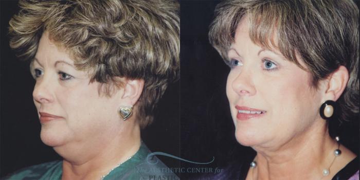 Before & After Neck Lift Case 1235 Oblique Right View: View in Houston, TX