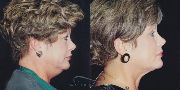 Before & After Neck Lift Case 1235 Side Right View: View in Houston, TX