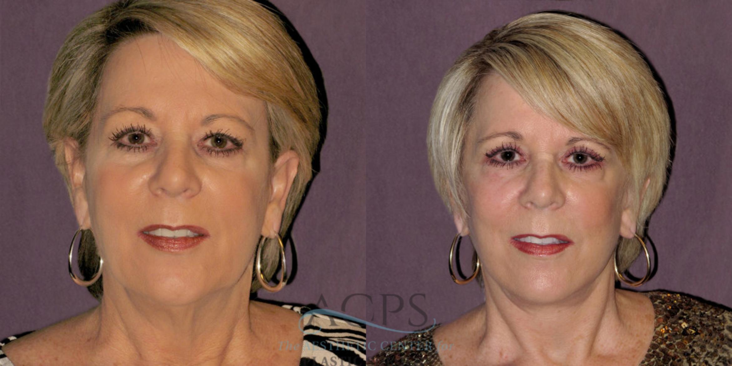 Before & After Facelift Case 1236 Front View: View in Houston, TX
