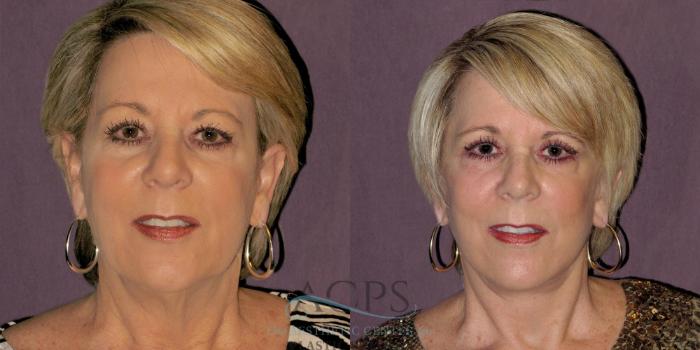Before & After Facelift Case 1236 Front View: View in Houston, TX