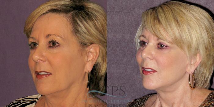 Before & After Facelift Case 1236 Oblique Left View: View in Houston, TX