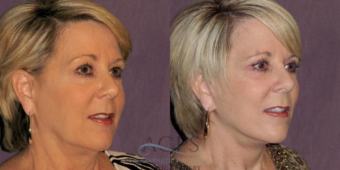 Before & After Facelift Case 1236 Oblique Right View: View in Houston, TX