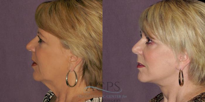 Before & After Facelift Case 1236 Side Left View: View in Houston, TX
