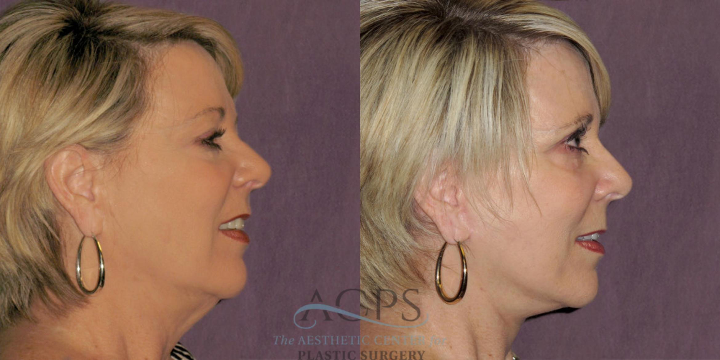 Before & After Facelift Case 1236 Side Right View: View in Houston, TX