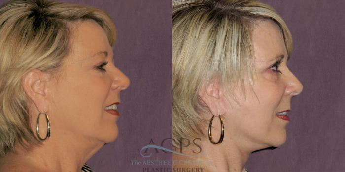 Before & After Facelift Case 1236 Side Right View: View in Houston, TX