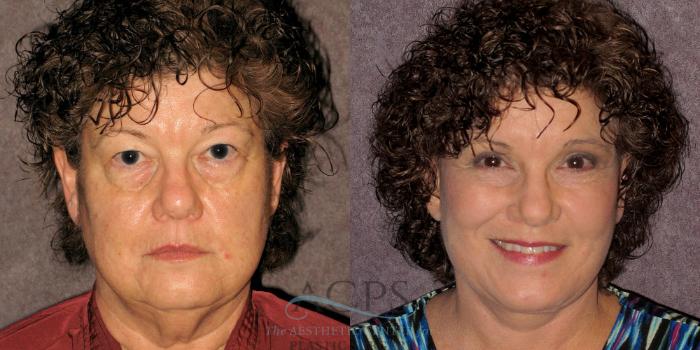 Before & After Neck Lift Case 1237 Front View: View in Houston, TX