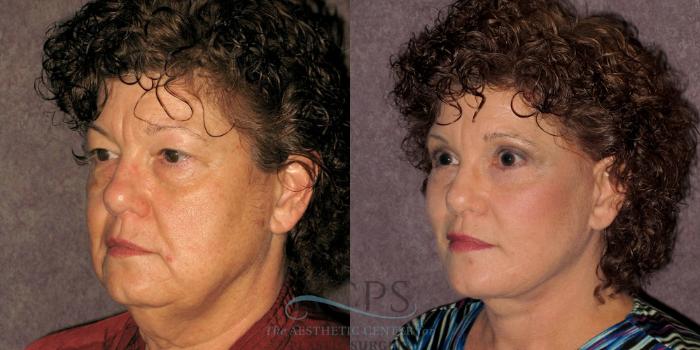Before & After Neck Lift Case 1237 Oblique Left View: View in Houston, TX