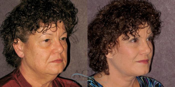 Before & After Neck Lift Case 1237 Oblique Right View: View in Houston, TX
